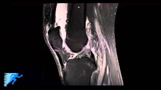 How to Read Knee MRI of LCL Tear  Complex Knee Surgeon  Posterolateral Corner Injury Minnesota MN [upl. by Hollinger676]