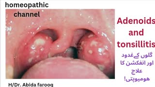 ADENOIDS AND TONSILLITIS Treatment in homeopathy [upl. by Arebma266]