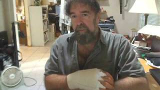 Trigger Finger Surgery PostOP aftermath  explained by Mickey Stein Trigger Finger Part 2 [upl. by Merill]