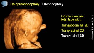 Holoprosencephaly face ethmocephaly 3D ultrasound scan [upl. by Minardi]