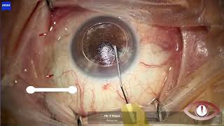 DALK Deep Anterior Lamellar Keratoplasty [upl. by Robyn240]