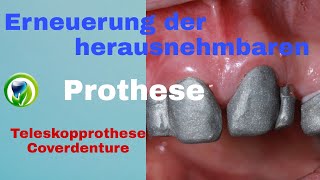 Erneuerung der herausnehmbaren Teilprothese  Teleskopprothese  Coverdenture [upl. by Fritts]