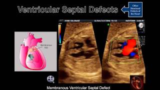 Fetal Echocardiography Ventricular Septal Defects [upl. by Leatri269]