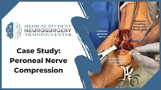 Case Study Peroneal Nerve Compression [upl. by Hinda]