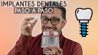 ¿Cómo se ponen los Implantes Dentales Paso a Paso 🔩 ¿Duelen  Odontología Láser [upl. by Hartman539]