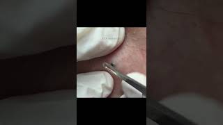 This Weeks TOP Extractions with Dr Pimple Popper [upl. by Fraser23]