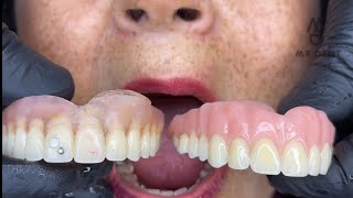 PRÓTESIS DENTAL FLEXIBLE O ACRILICA  🤔🤔 viral odontologia fypシ [upl. by Hali96]