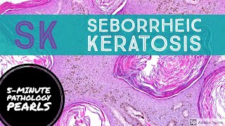 Seborrheic Keratosis 5Minute Pathology Pearls [upl. by Bruell]