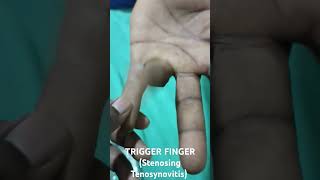 TRIGGER FINGER Stenosing Tenosynovitis flexordigitorumprofundus [upl. by Eiramoj]