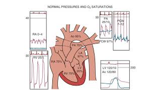 Right Heart Catheterization  an introduction [upl. by Brannon832]