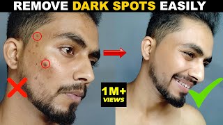 DARK SPOT कैसे हटाये  How To Remove DARK SPOTS amp SCARS NATURALLY ACNE SCARS ACNE MARK  2021 [upl. by Aruasi]