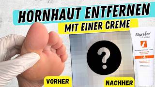 HORNHAUT ENTFERNEN MIT EINER CREME Die HORNHAUTREDUZIERCREME von Allpresan im 14 Tage Test [upl. by Brandwein358]