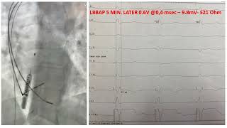 LBBAP WITH BIOTRONIK SYSTEM [upl. by Grof]