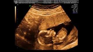 EMBARAZO 14 SEMANAS  ECOGRAFIA 3D y 4D de nuestro peke  ULTRASOUND 14 WEEKS SUANSI [upl. by Zerlina]