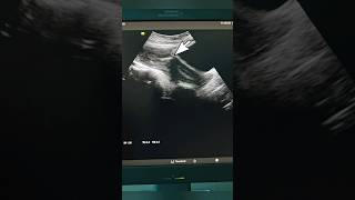 Displaced IUCD on Ultrasound medical ultrasound health pregnancy uterus familyplanning viral [upl. by Nima]