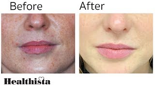 Rejuvenate Lips with Belotero Fillers Treatment [upl. by Ardel]