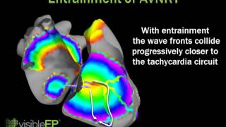 Entrainment of AVNRT [upl. by Stickney]