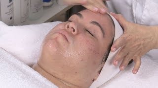 Diet Related Acne And Facial With Alessandra Part 3 [upl. by Haslett]