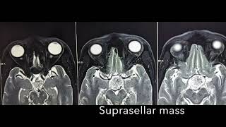 Suprasellar mass Craniophyryngioma Pterional Craniotomy Dr Akshay Vijay Kulkarni MCH [upl. by Akemit]