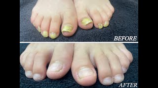 Laser Fungal Nail treatment in 8 year old boy Part 2 [upl. by Elephus]