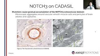 CADASIL  Stroke and Vascular Dementia in adults by Ricardo Carrillo Meza [upl. by Einavoj]