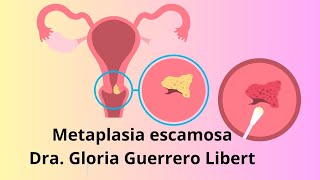 Metaplasia Escamosa en mi papanicolaou ¿Que hacer [upl. by Lita436]