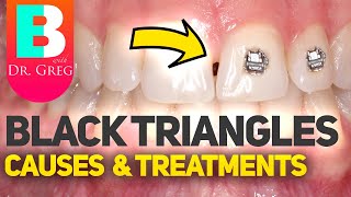 Tooth Gaps  Black Triangles with Braces or Invisalign [upl. by Lleval]