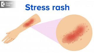 What is a stress rash  Dr Rajdeep Mysore [upl. by Jannery]