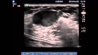 Fibroadenosis of breast hydrodissection [upl. by Cressy]