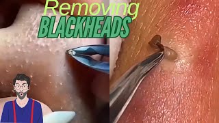 Removing blackheads and Whiteheads 😲 satisfying blackheads whiteheads [upl. by Vallonia]