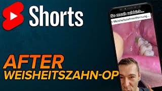 Nach Weisheitszahnentfernung shorts [upl. by Barger762]