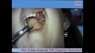 Infiltration Anesthesia for extration 232627 teeth [upl. by Marline912]