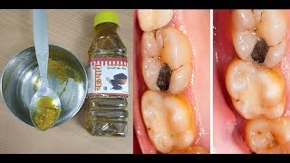 दांत का कीड़ा 2 मिनट में बहार निकाल देगा ये घरेलू नुस्खाhow To Get Rid Of Tooth Cavity [upl. by Sherj]