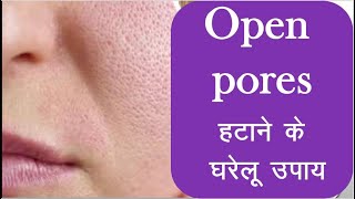 Open pores home remedy  Open pores treatment  चेहरे के रोम छिद्र कैसे बंद करें [upl. by Joost587]