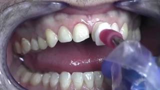 Montarea fatetelor dentare la Implant3D [upl. by Yttam]