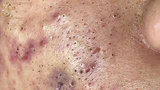 Blackheads Extraction Whiteheads Removal Pimple Popping 2 [upl. by Ninnahc]