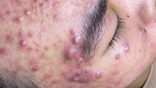 Big Cystic Acne Blackheads Extraction Blackheads amp Milia Whiteheads Removal Pimple Popping  3965 [upl. by Wolf]