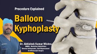 Balloon Kyphoplasty explained by Dr Abhishek Kumar Mishra [upl. by Willard]