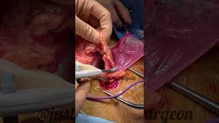 Inside the OR with justageneralsurgeon  hernia contents amp ligasure of omental fat before repair [upl. by Keeryt]