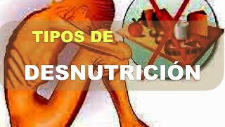 Tipos de Desnutrición [upl. by Ehtylb]