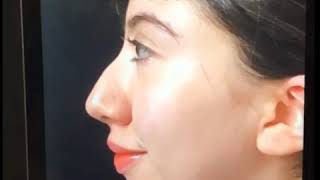 Designer Rhinoplasty Chin Implant and Liposuction of the neck by Dr Kassir [upl. by Hsirk]