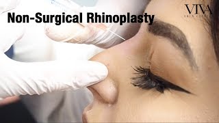 NonSurgical Rhinoplasty  VIVA Skin Clinics [upl. by Atilam]