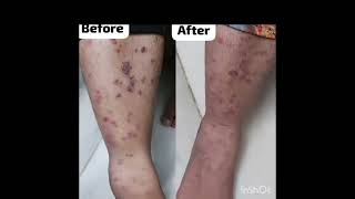 STOP SKIN PROBLEMS WITH HOMOEOPATHY [upl. by Samohtnhoj384]