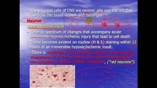 CNS  Pathology  Cerebrovascular disease [upl. by Brackely599]