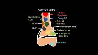 Bony Tumors Review 1 [upl. by Cherri]