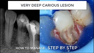 Subgingival Class V We need absolute dam isolation gingivectomy teflon and endodontics [upl. by Bottali98]