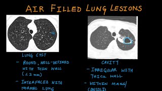 CYSTIC LESIONS OF LUNG  Types amp Definitions How to differentiate between each [upl. by Nivag]