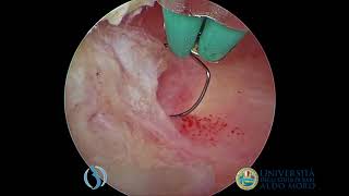 Kissing Myomas with KS MiniResectoscope in an Office setting [upl. by Llerred]