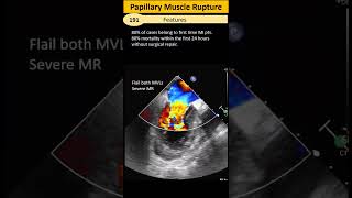 Papillary muscle rupture [upl. by Lillie273]