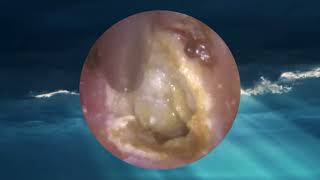 Eardrum about to EXPLODE after Blocked Ear Wax Removal using Endoscopic Ear Microsuction [upl. by Gotthard]